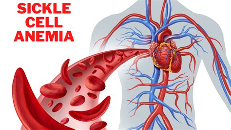 Sickle Cell Anemia Symptoms Causes Symptoms And Treat Vrogue Co