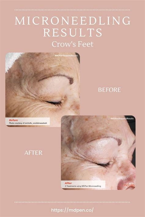 microneedling before and after crow s feet and sunspots microneedling professional skin care