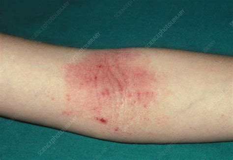 Atopic Eczema On The Inside Of The Elbow Stock Image M1500082