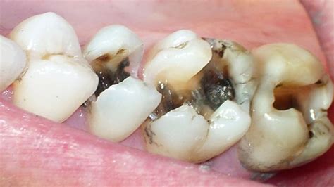 Sakit Gigi Karena Berlubang Apa Obatnya - Cara Menghilangkan Sakit Gigi Berlubang Secara Alami Dan Cepat