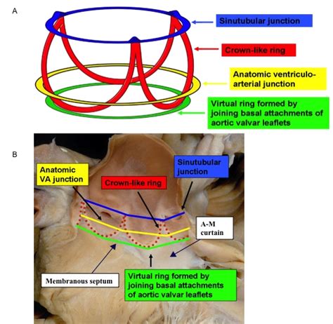 Aortic Valve Annulus