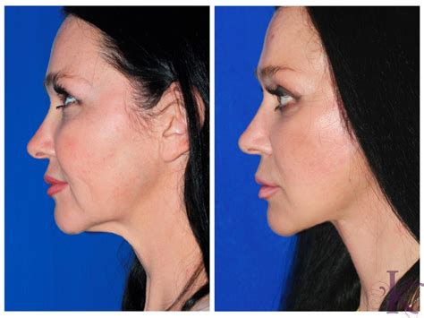 Facelift Before After Dr Vasyukevich Facial Plastic Surgeon Nyc 78
