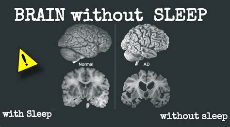 What Will Happen To Your Brain If You Dont Sleep By Unup Medium
