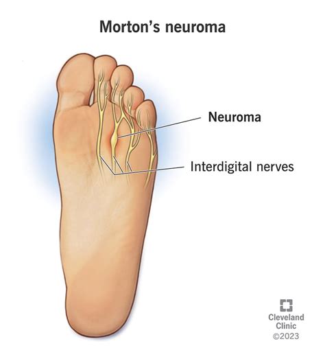 Mortons Neuroma Causes Symptoms And Treatment