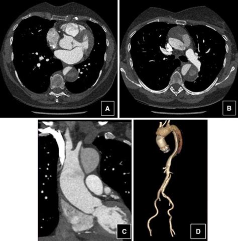 A B Axial Visualization At Ct Scan Of The Ascending Aorta Below And