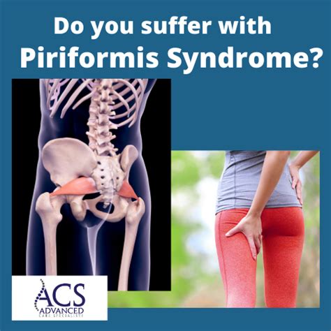 Piriformis Syndrome Advanced Care Specialists