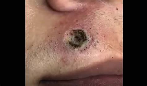 Ingrown Hair Cyst Removal New Pimple Popping Videos