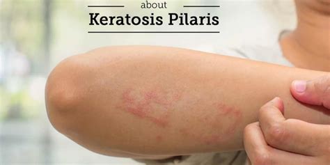 Our Expert Guide To Keratosis Pilaris Aka Chicken Skin The Naked My Xxx Hot Girl