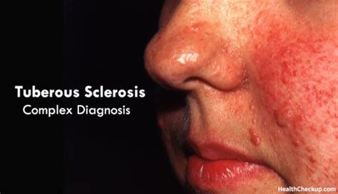 Tuberous Sclerosis Complex Tsc Causes Signs Treatment Diagnosis