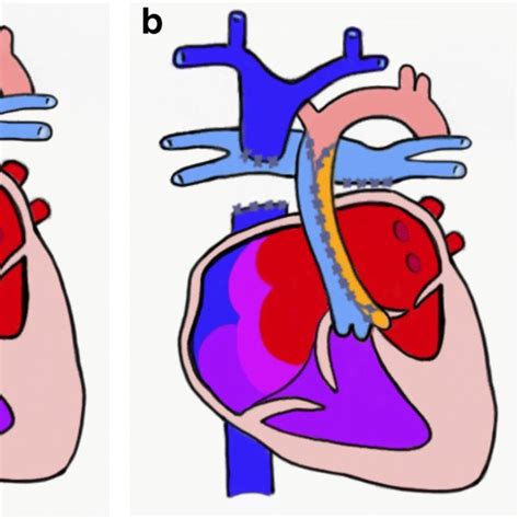 Fontan Surgery Simplified Ac In Hypoplastic Left Heart Syndrome A