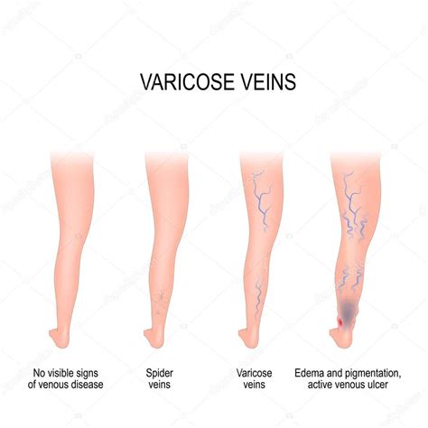 Stages Of Varicose Veins — Stock Vector © Edesignua 173779130