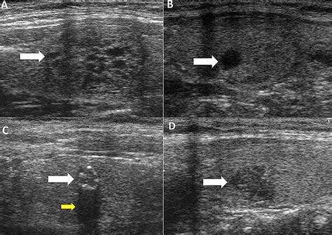 Cureus B Mode Ultrasound Characteristics Of Thyroid Nodules With High