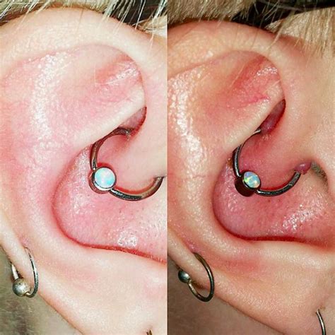 Piercing Near Me Infected Bump On Ear Lobe Piercing