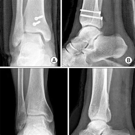 A B Immediate Postoperative X Ray Showed Anatomical Reduction Of The