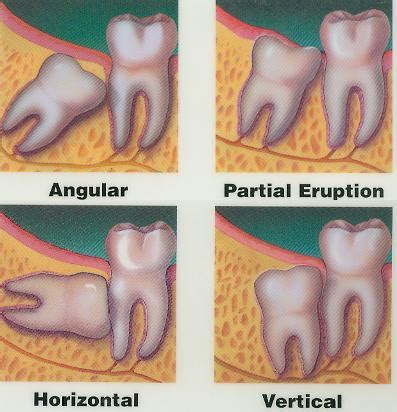 Pain and swelling in your gums and sudden ache around the wisdom tooth hole. About Tooth Extractions | Intelligent Dental