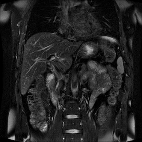 Primary Sclerosing Cholangitis Image