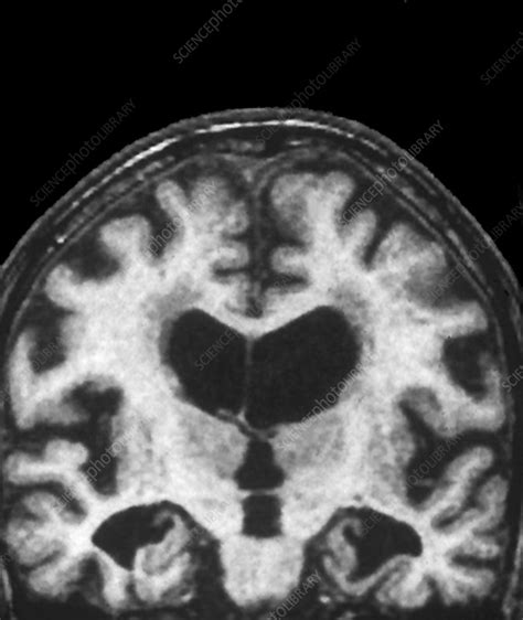 Alzheimers Disease Brain Mri Scan Stock Image C0041460 Science