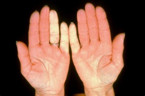 تصلب الجلد Scleroderma ظاهرة رينو اليدين الشحوب Raynauds Phenomenon
