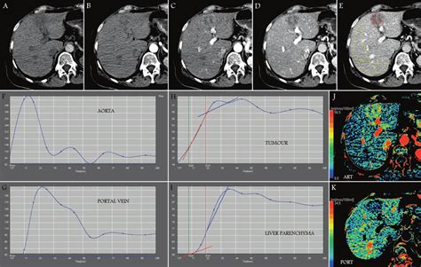 Dynamic Contrast Enhanced Ct Examination Of A Patient With A Large