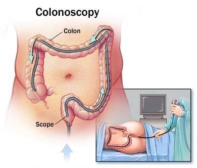 A screening colonoscopy is coded and covered differently than a diagnostic. Paleo Colonoscopy Prep - Mangia Paleo