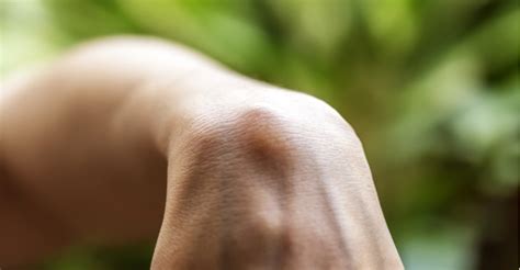 Lumps And Bumps On The Skin Southfield Livonia Mi Arora Hand Surgery