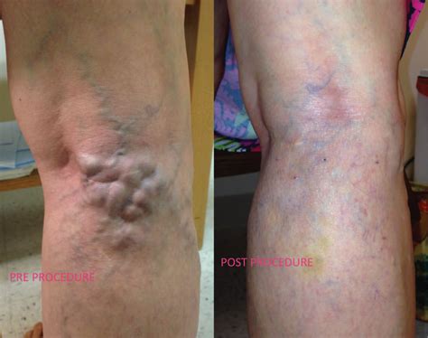 Removal Of Varicose Veins Microphlebectomy In Chesapeake Va