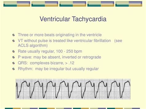 Ventricular Tachycardia Causes Symptoms And Diagnosis