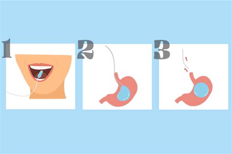 gastric balloon the complete guide