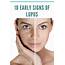 10 Early Signs Of Lupus – Schoen Med