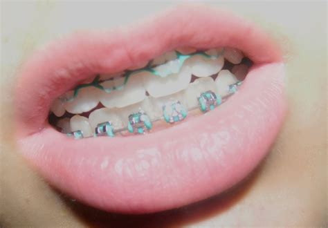 light blue braces for you