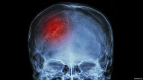 Derrame Cerebral Como Identificar Os Primeiros Sintomas De Um Avc