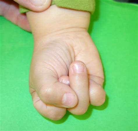 Challenges With Cleft Hand Reconstruction Congenital Hand And Arm