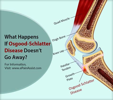 What Happens If Osgood Schlatter Disease Doesnt Go Away And When To Go