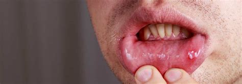 What Causes Mouth Ulcers Treatment And Prevention Canstar