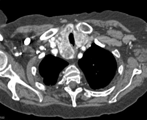 Substernal Extension Of Thyroid Goiter Chest Case Studies Ctisus Ct