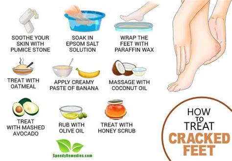 How To Treat Cracked Feet Speedy Remedies
