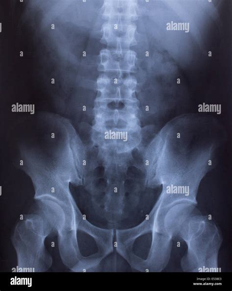 Radiología De Pelvis Mujer Fotografías E Imágenes De Alta Resolución