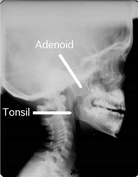 Adenoid Hypertrophy X Ray