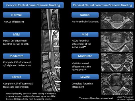 Comparison Of Mri Grading For Cervical Neural Foraminal Stenosis Based