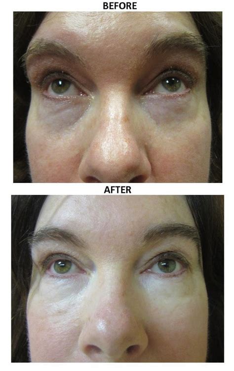 Before And After Fillers Tear Troughs Photos The Medical Spa