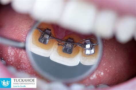 Lingual Braces What Are They And What Should You Know