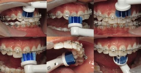 Over time, bristles get worn down and don't clean your teeth as well. Flossing And Brushing With Braces - Fraser Dental ...