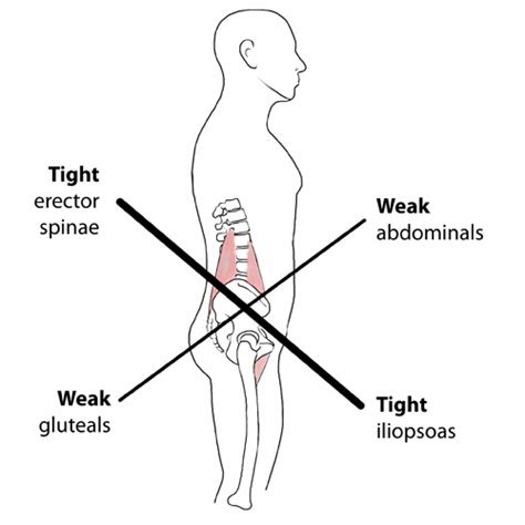 Lower X Syndrome Lower Crossed Syndrome