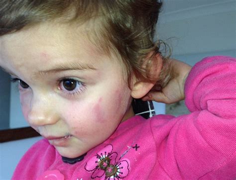 Shocking Pictures Emerge Of Two Year Old Girl Bruised Scratched And