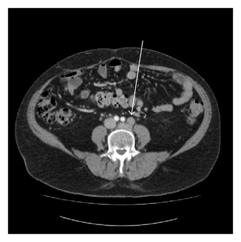 A Illustrated Ct Of The Thorax With Pretreatment Bilateral Axillary