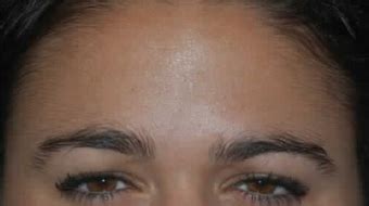 Layout using named grid lines. Botox Before & After Pictures - RealSelf