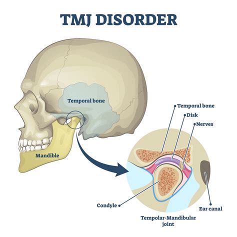 Your Guide To Tmj Disorder Encino And San Fernando Valley Ca