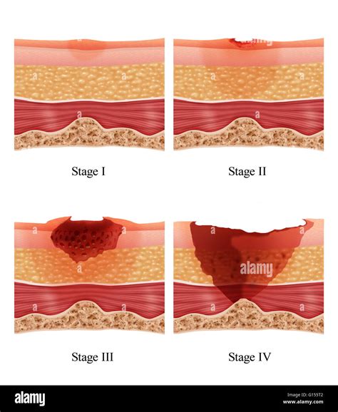 Decubitus Ulcer Bed Sore Stages See More On ToolCharts Important You