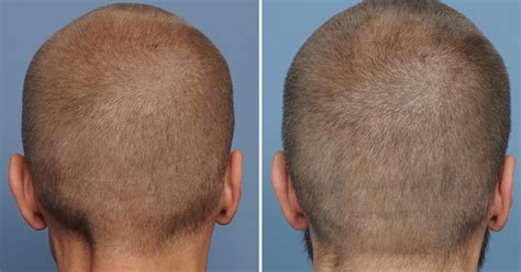 Male Occipital Skull Reduction Scar Back View Dr Barry Eppley