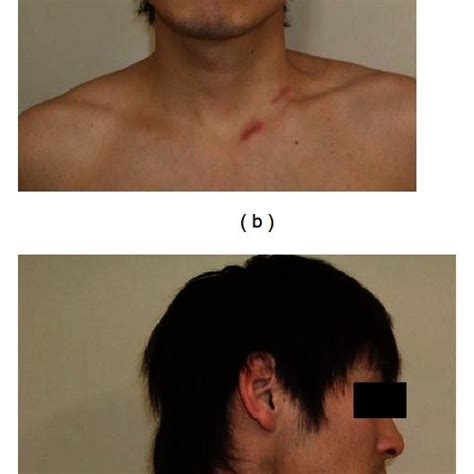 Pdf A Surgical Treatment For Adult Muscular Torticollis